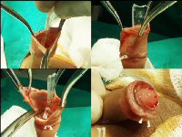 Plastibell� circumcision